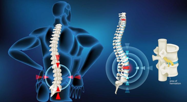 نقش پررنگ ژنتیک در ابتلا به دیسک کمر